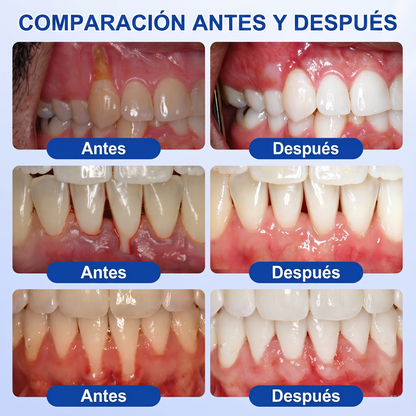 Zoencgz® 🦷🧴 Gel antibacteriano para la regeneración de las encías | Resultados visibles en 7 días