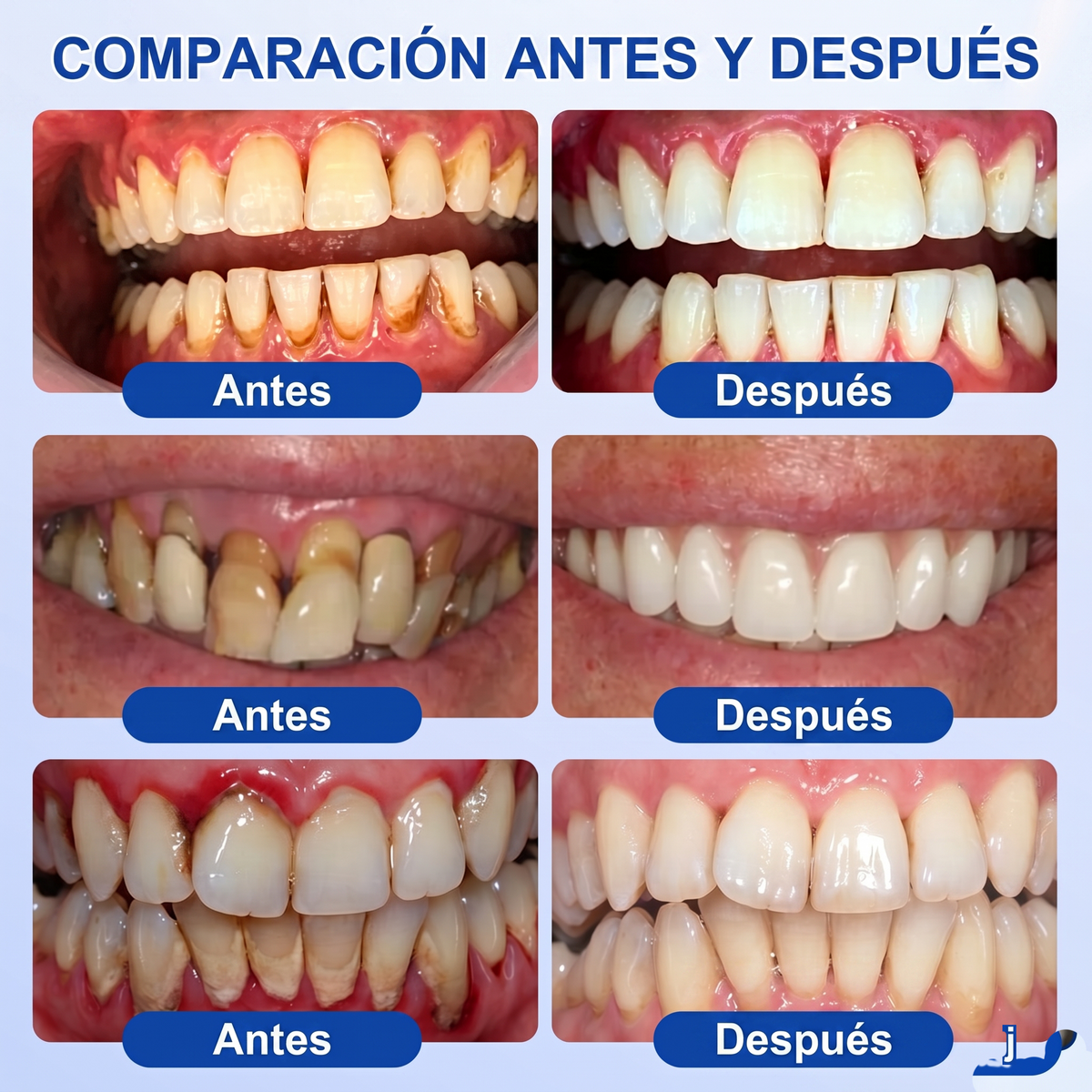 Zoencgz® 🦷🧴 Gel antibacteriano para la regeneración de las encías | Resultados visibles en 7 días